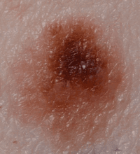 Melanoma from a mole with changing shape and colour.