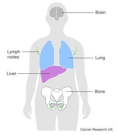 Diagram showing where in the body cancer tends to spread to.