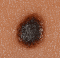 Melanoma that has developed from a long standing mole that is starting to spread.