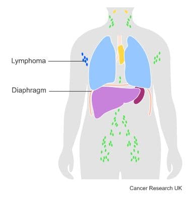 Medical diagram - Lymphoma.