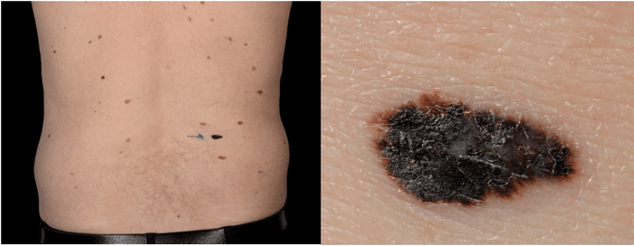New, dark lesion on the skin proven to be a melanoma.