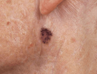 Photograph of pigmented basal cell cancer.