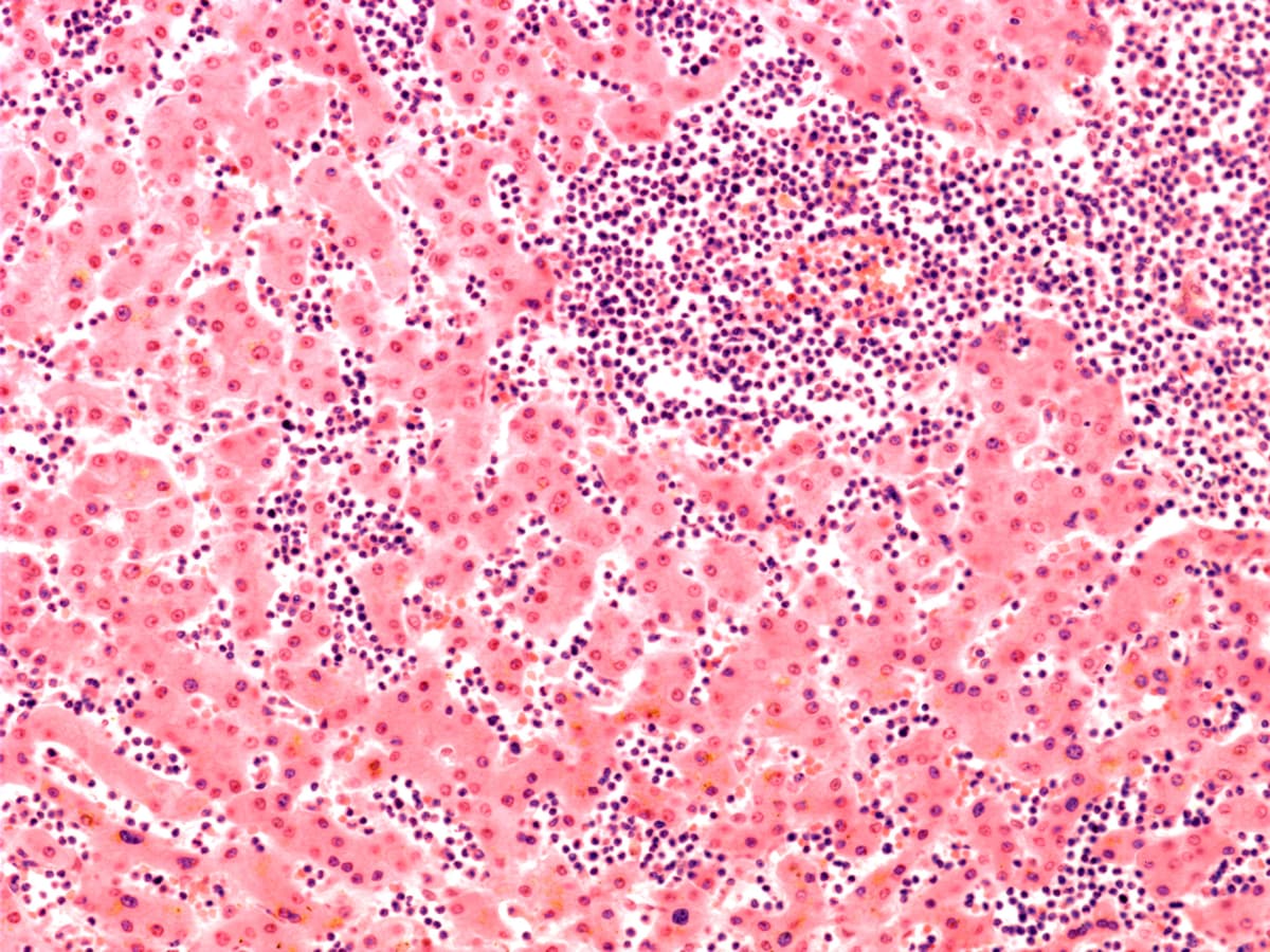 Image of leukaemia cells.