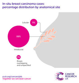 Infographic showing the most common specific location for in situ breast carcinomas in the UK is in the cells lining the milk ducts (2016-2018).