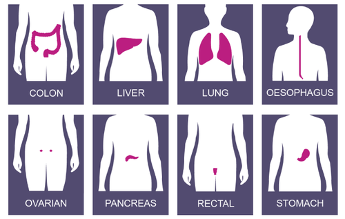 ICBP cancer types
