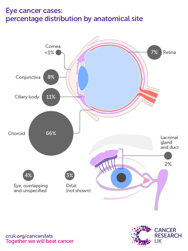 infographic showing the most common specific location for eye cancers in the UK is the choroid (2016-2018).