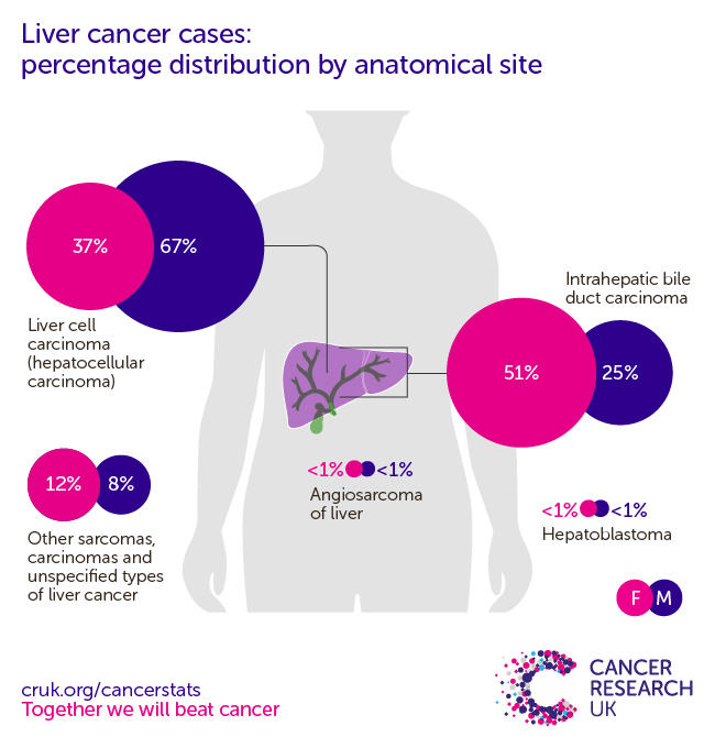 a infoographic showing In females, the most common specific type of liver cancer in the UK is intrahepatic bile duct carcinoma, in males the most common specific type of liver cancer in the UK is hepatocellular carcinoma (2016-2018).