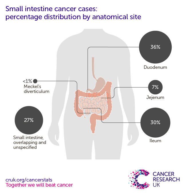 a infographic showing the most common specific location for small intestine cancers in the UK is the duodenum (2016-2018).