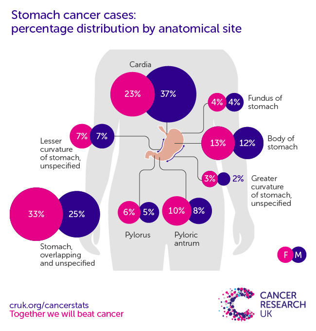 Infographic showing the most common specific location for stomach cancers in the UK is the cardia 
