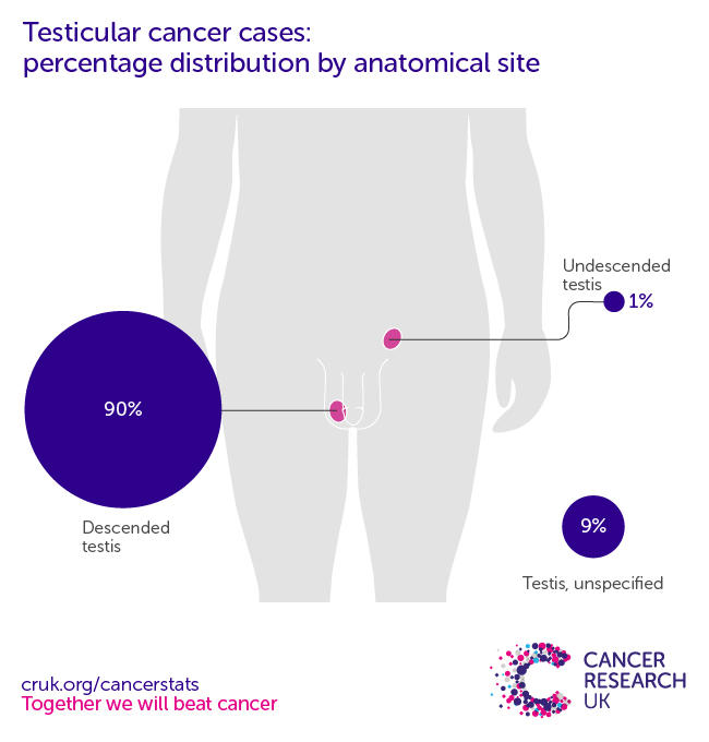 Infographic showing the most common specific location for testicular cancers in the UK is descended testes